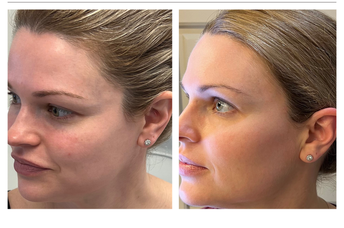Left Picture: The Left side of a female patient's face before BBL HERO and Moxi of note there is underlying redness, uneven pigment, minimal freckling and dry appearance. Overall, though the patient's complexion shows room for seemingly little improvement.  Right Picture: Here we see a significant improvement in underying redness, uneven skin tone, and a healthy glow to the patients skin after the combination treatment with BBL HERO plus Moxi. 