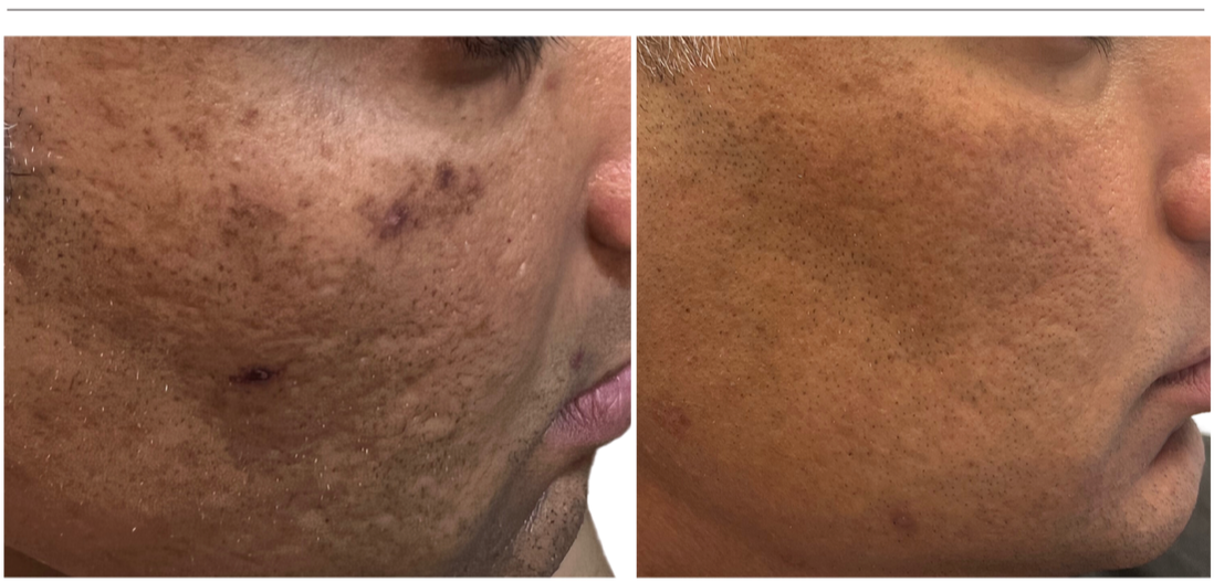Picture Left: The Right side of a male patient’s face with Fitzpatrick grade 5 skin, melasma and post-inflammatory hyperpigmentation with uneven pigment and skin texture, hyperpigmented spots and dull dry skin. The patient skin was pre-treated.  Picture Right: The Right side of the male patient’s face following 6 BBL HERO treatments and 2 Moxi treatments.  Since the patient’s skin is a Fitzpatrick grade 5 treatments are lower energy and require a calculated and cautious approach in order to transform his skin. 