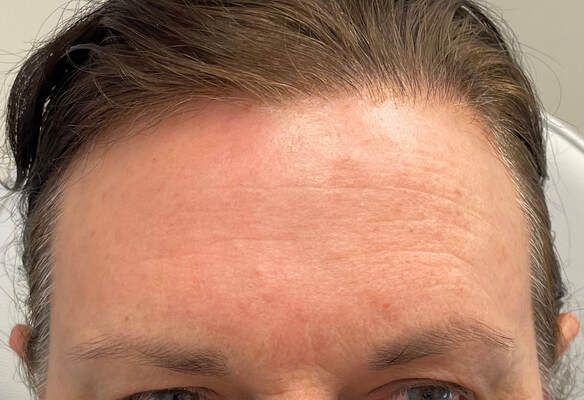 After a single BBL HERO and Moxi treatment. Picture of a patient's forehead showing significant improvement in deep wrinkling, underlying redness and pigment changes associated with sun damage. 