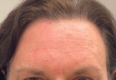 The before BBL HERO and Moxi picture of a patient's forehead with deep wrinkling more so on their left side. Often associated with sun exposure to that side of the face while driving without sun protection. 