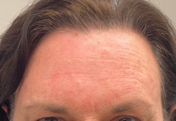 The before BBL HERO and Moxi picture of a patient's forehead with deep wrinkling more so on their left side. Often associated with sun exposure to that side of the face while driving without sun protection. 