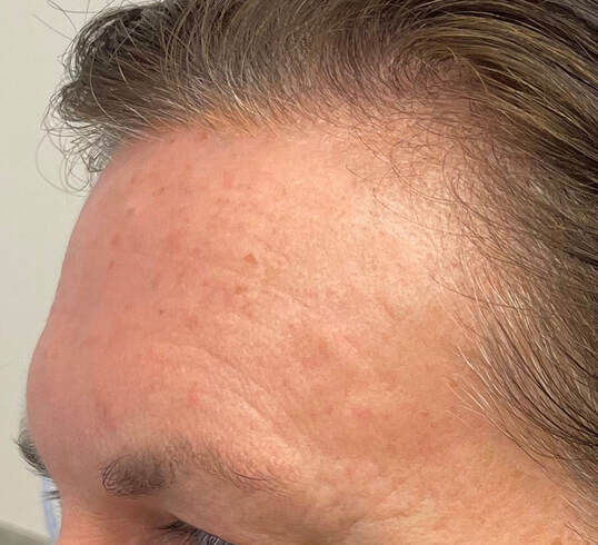 After a single BBL HERO and Moxi treatment. Picture of the left side of the patient's forehead showing significant improvement in deep wrinkling, underlying redness and pigment changes associated with sun damage. 
