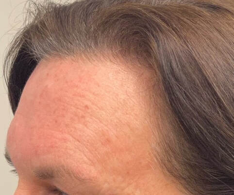 The before BBL HERO and Moxi picture of the left side of a patient's forehead with deep wrinkling more so on their left side. Often associated with sun exposure to that side of the face while driving without sun protection. 